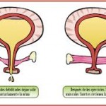 Fisioterapia en mujeres con incontinencia urinaria