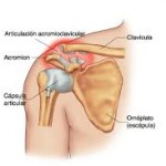 Esguince acromioclavicular