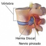 ¿Tener una hernia implica dolor?