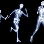 Osteoporosis