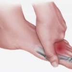 Neuroma de Morton