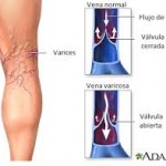 Varices: lo que necesitas saber.