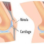 Síndrome de Hiperpresión Rotuliana Externa o Condromalacia Rotuliana.