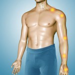 Mielopatía cervical