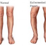 Enfermedad de Paget: ¿Qué es?