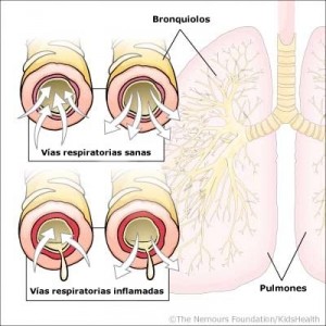 Bronquiolitis Aguda Infantil