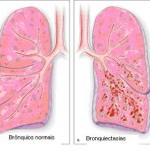 Fisioterapia respiratoria en las bronquiectasias: objetivos y beneficios.