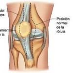 Luxación de Rótula: factores de riesgo y signos y síntomas