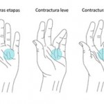 Enfermedad de Dupuytren: fisioterapia postoperatoria.