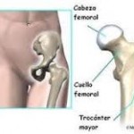 Bursitis trocantérea