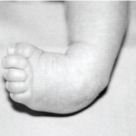 Fisioterapia infantil en el pie zambo