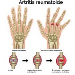 Artritis reumatoide y tratamiento de fisioterapia