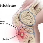 Enfermedad de Osgood-Schlatter