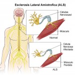 Esclerosis Lateral Amiotrófica