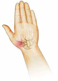 Rizartrosis o artrosis del pulgar. Síntomas, tratamiento y