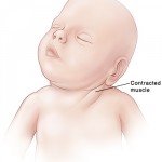 Tortícolis muscular congénita