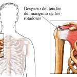 Desgarro del manguito rotador
